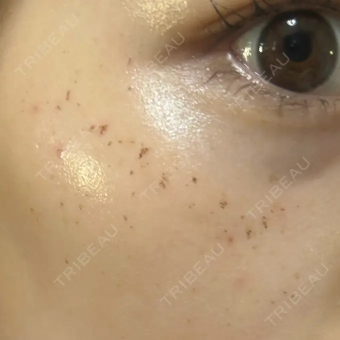 イオン導入 / ルメッカ ルラ美容クリニック 池袋院 DAY 3 メイン用