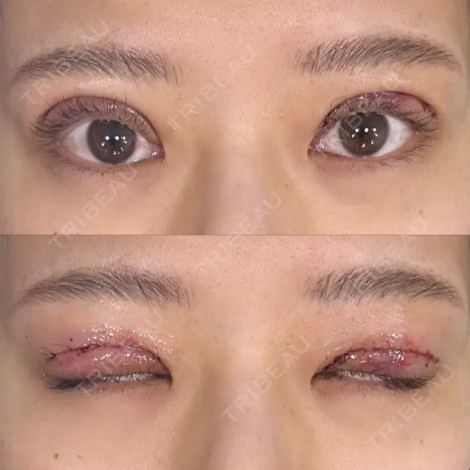 二重切開 / 眼瞼下垂（切開） eクリニック 新宿院 DAY 0 メイン用