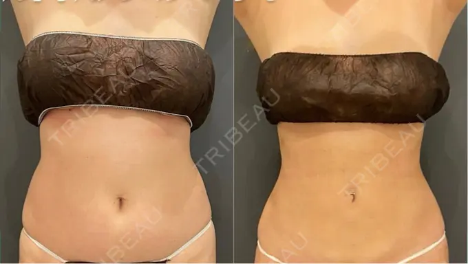 脂肪吸引（お腹） / 脂肪吸引（腰） オアシス美容外科 DAY 34 メイン用