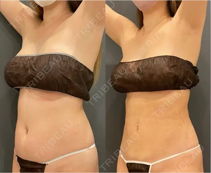 脂肪吸引（お腹） / 脂肪吸引（腰） オアシス美容外科 DAY 34 メイン用