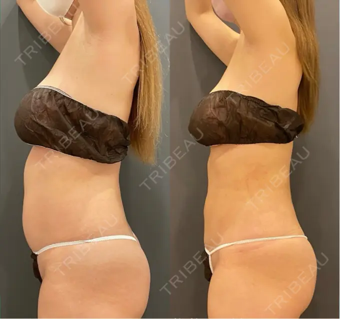 脂肪吸引（お腹） / 脂肪吸引（腰） オアシス美容外科 DAY 34 メイン用