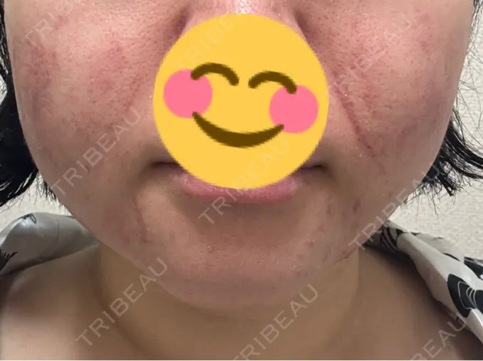 RF（高周波）たるみ治療 Clinic K Blossom DAY 0 メイン用