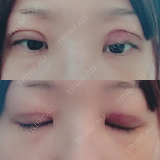 二重切開 城本クリニック 豊橋院 DAY 9 メイン用