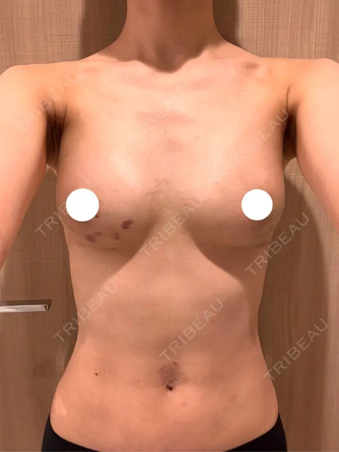 脂肪吸引（お腹） / 豊胸（脂肪注入） / 脂肪吸引（背中） ルーチェクリニック 銀座院 DAY 8 メイン用