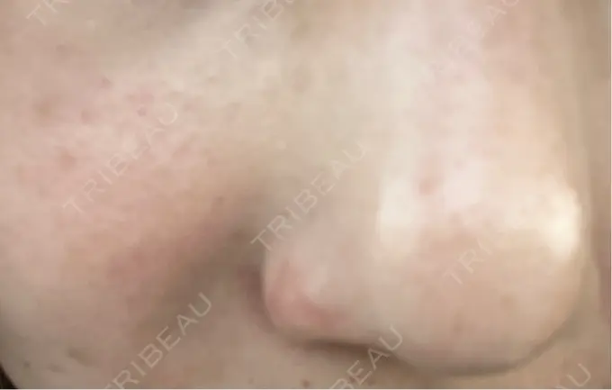 水光注射（ハリ・美肌） / ダーマペン KM新宿クリニック DAY 1 メイン用