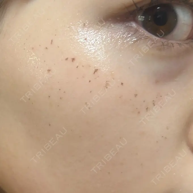 イオン導入 / ルメッカ ルラ美容クリニック 池袋院 DAY 4 メイン用