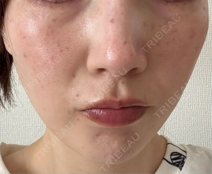 シミ取りレーザー / ピコスポット アモーレクリニック 名古屋院 AFTER メイン用