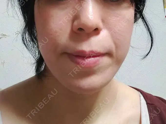 RF（高周波）たるみ治療 表参道メディカルクリニック 表参道院 DAY 28 メイン用