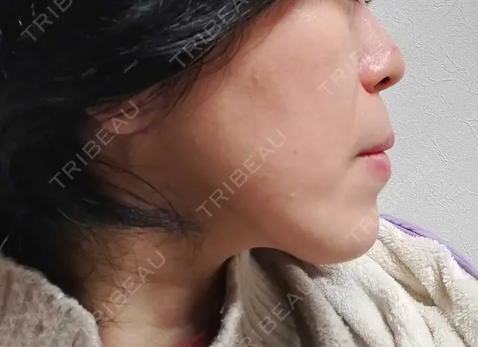 RF（高周波）たるみ治療 表参道メディカルクリニック 表参道院 DAY 37 メイン用