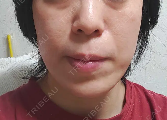 RF（高周波）たるみ治療 表参道メディカルクリニック 表参道院 DAY 47 メイン用