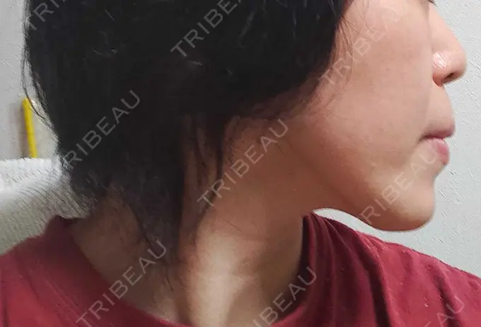 RF（高周波）たるみ治療 表参道メディカルクリニック 表参道院 DAY 47 メイン用