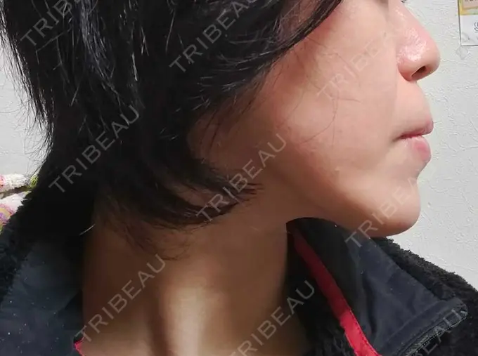 RF（高周波）たるみ治療 表参道メディカルクリニック 表参道院 DAY 57 メイン用