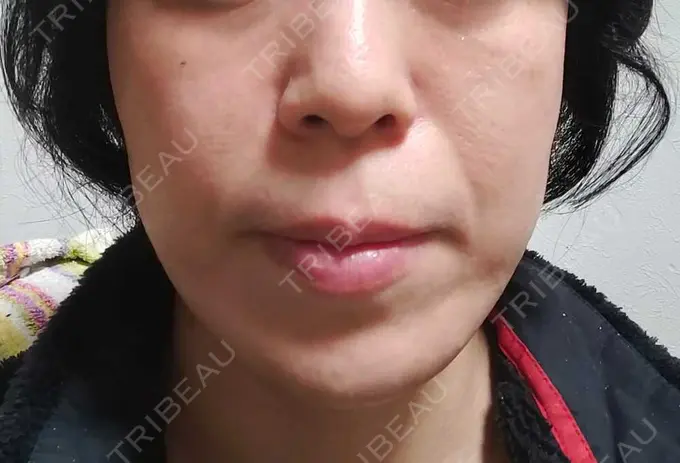 RF（高周波）たるみ治療 表参道メディカルクリニック 表参道院 DAY 57 メイン用