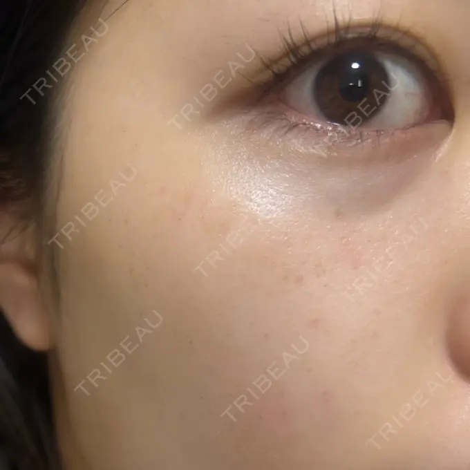 イオン導入 / ルメッカ ルラ美容クリニック 池袋院 DAY 5 メイン用