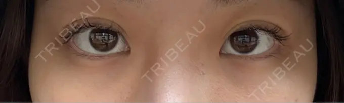 二重埋没 / 目元修正 水の森美容クリニック 東京渋谷院 DAY 3 メイン用