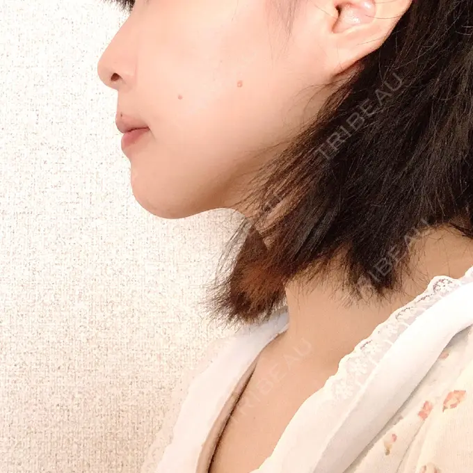 セットバック 大塚美容形成外科・歯科 大塚本院 DAY 97 メイン用