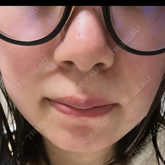 毛穴洗浄（ハイドラフェイシャルなど） / レーザートーニング（美白・肝斑） 表参道ウィズ・クリニック AFTER メイン用