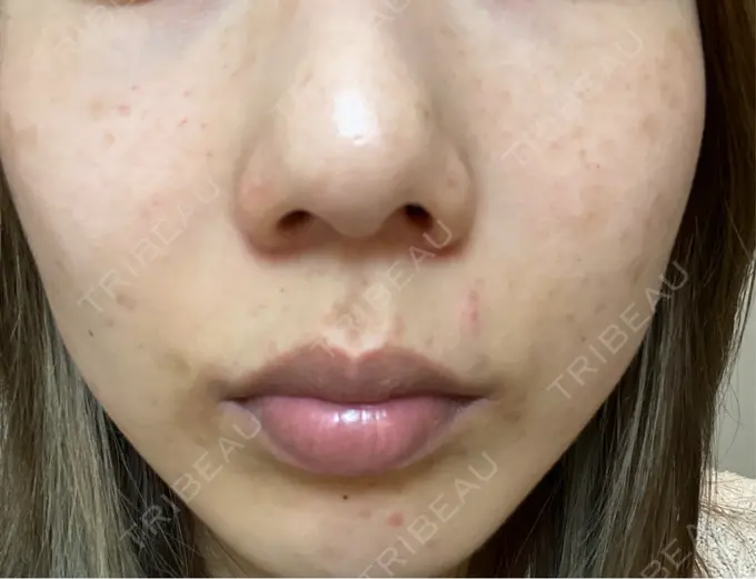 水光注射（ハリ・美肌） / ダーマペン KM新宿クリニック DAY 2 メイン用