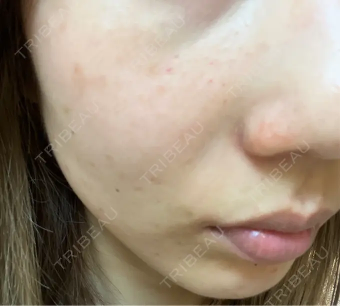 水光注射（ハリ・美肌） / ダーマペン KM新宿クリニック DAY 2 メイン用