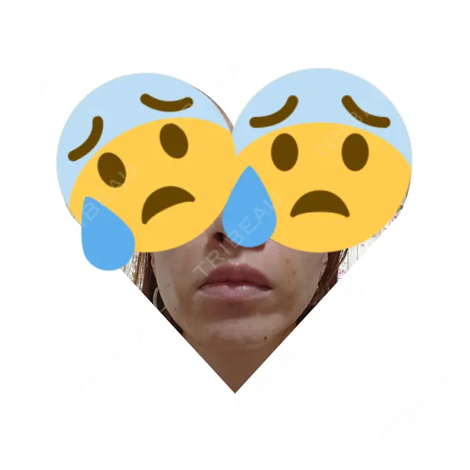 脂肪注入（肌） 広島プルミエクリニック DAY 8 メイン用