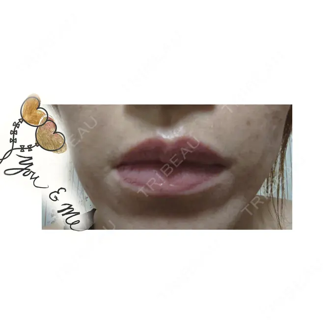 脂肪注入（肌） 広島プルミエクリニック DAY 8 メイン用