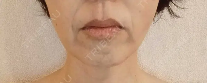 糸リフト 湘南美容クリニック 吉祥寺院 AFTER メイン用