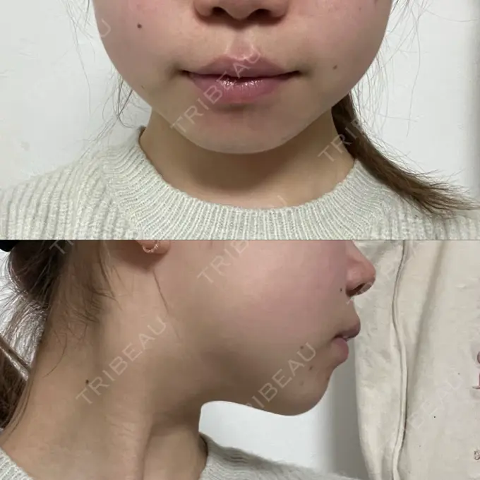 RF（高周波）たるみ治療 大美会クリニック 梅田院 DAY 13 メイン用