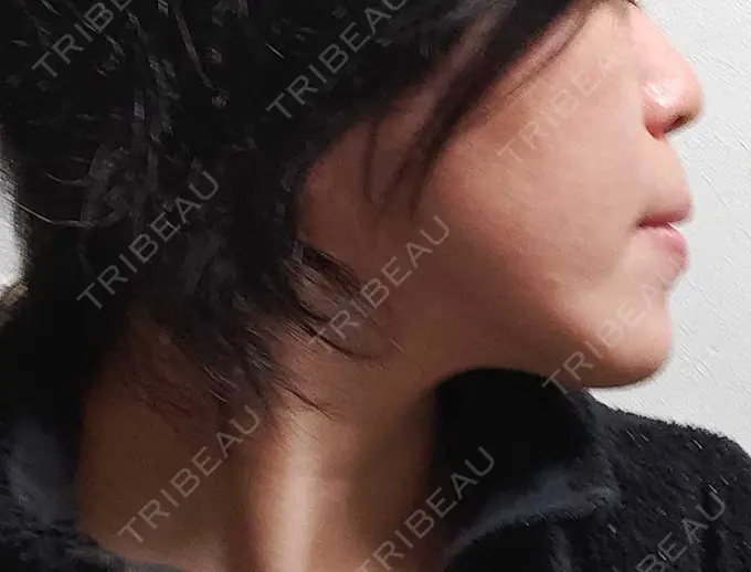 RF（高周波）たるみ治療 表参道メディカルクリニック 表参道院 DAY 61 メイン用