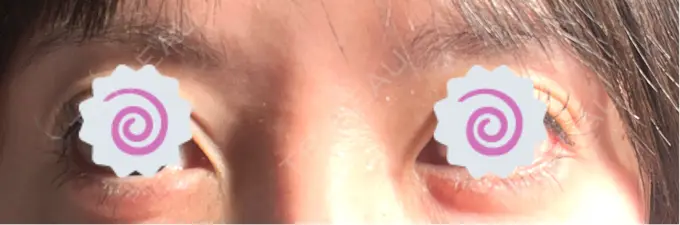 ヒアルロン酸注入（涙袋） / ボトックス（眉間） TCB東京中央美容外科 青森院 AFTER メイン用