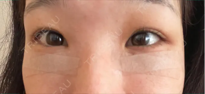 クマ治療 BELLMONA CLINIC DAY 1 メイン用