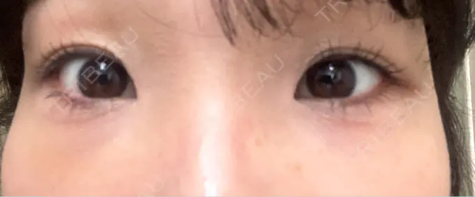 クマ治療 BELLMONA CLINIC DAY 3 メイン用