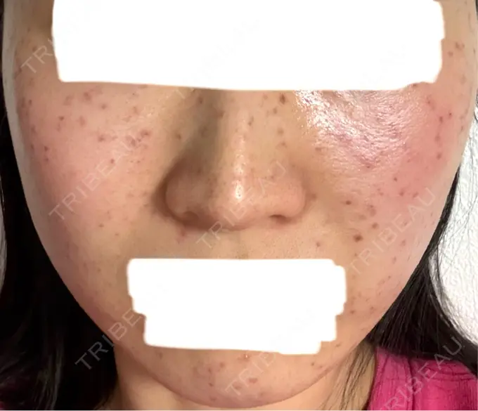 イオン導入 / シミ取りレーザー / ピコレーザートーニング（美白・肝斑） アモーレクリニック 名古屋院 DAY 0 メイン用