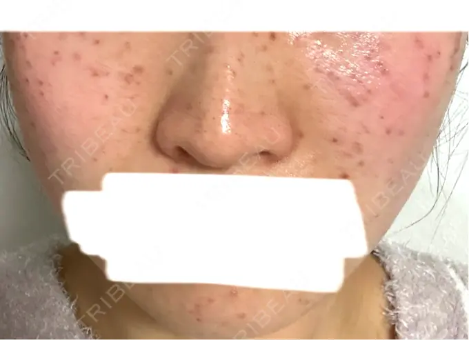 イオン導入 / シミ取りレーザー / ピコレーザートーニング（美白・肝斑） アモーレクリニック 名古屋院 DAY 1 メイン用