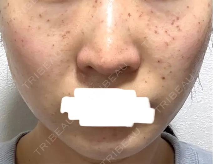 イオン導入 / シミ取りレーザー / ピコレーザートーニング（美白・肝斑） アモーレクリニック 名古屋院 DAY 3 メイン用