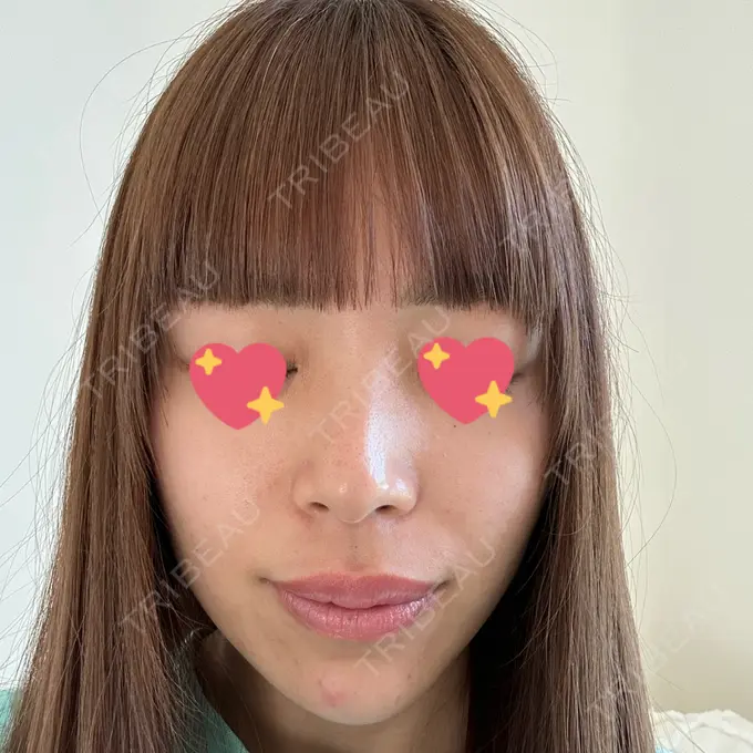 エレクトロポレーション / 毛穴洗浄（ハイドラフェイシャルなど） 心斎橋KT美容クリニック AFTER メイン用