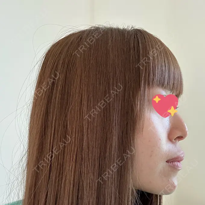 エレクトロポレーション / 毛穴洗浄（ハイドラフェイシャルなど） 心斎橋KT美容クリニック DAY 32 メイン用