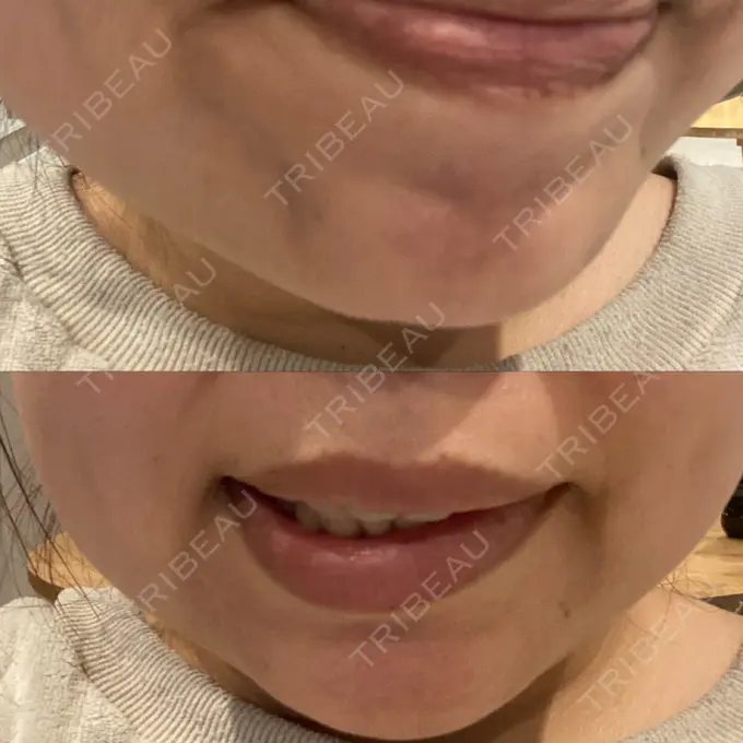 脂肪吸引注射（顔） / ボトックス（あご） / ボトックス（口角） / ボトックス（眉間） / その他（口元） TCB東京中央美容外科 静岡院 DAY 12 メイン用