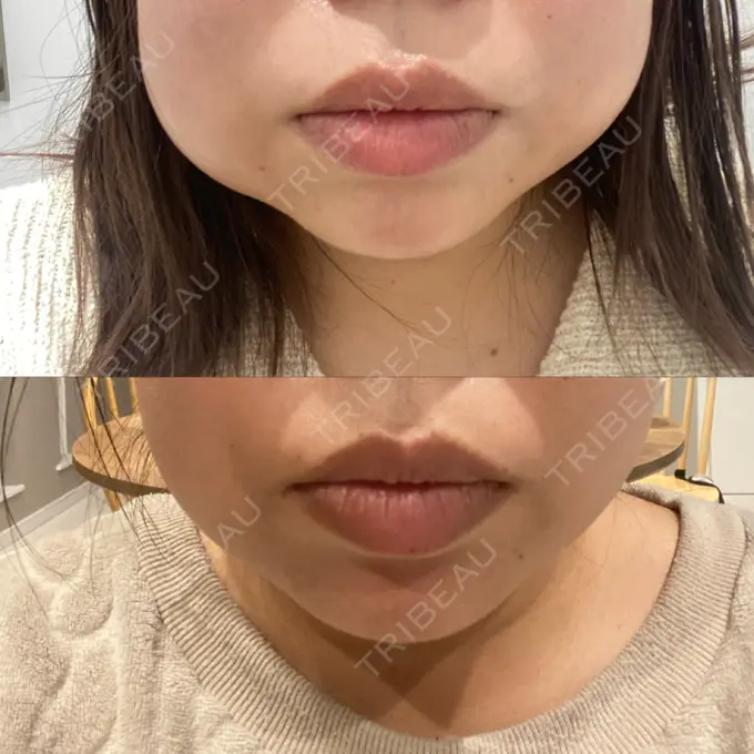 脂肪吸引注射（顔） / ボトックス（あご） / ボトックス（口角） / ボトックス（眉間） / その他（口元） TCB東京中央美容外科 静岡院 DAY 12 メイン用