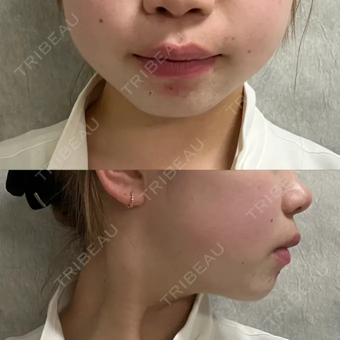 RF（高周波）たるみ治療 大美会クリニック 梅田院 DAY 14 メイン用