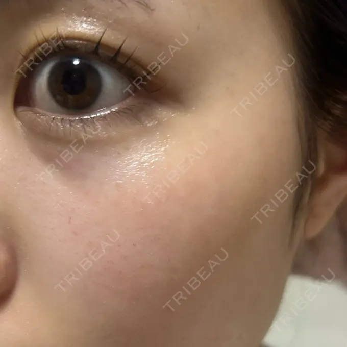 イオン導入 / ルメッカ ルラ美容クリニック 池袋院 AFTER メイン用