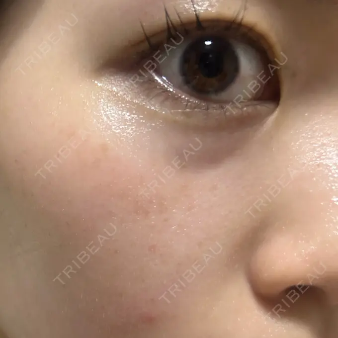 イオン導入 / ルメッカ ルラ美容クリニック 池袋院 DAY 7 メイン用