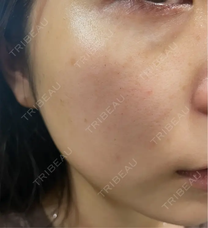 ルメッカ Chloe Cheongdam Clinic （クロエチョンダムクリニック） DAY 6 メイン用