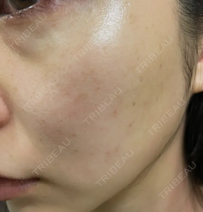 ルメッカ Chloe Cheongdam Clinic （クロエチョンダムクリニック） DAY 6 メイン用