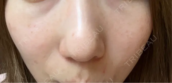 水光注射（ハリ・美肌） / ダーマペン KM新宿クリニック DAY 3 メイン用