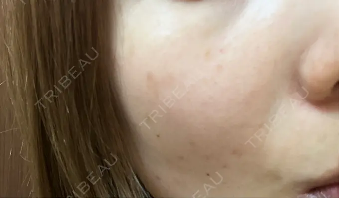 水光注射（ハリ・美肌） / ダーマペン KM新宿クリニック DAY 3 メイン用