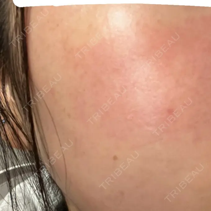 ピコレーザートーニング（美白・肝斑） / ピコフラクショナルレーザー（毛穴・ニキビ跡） 東京シルククリニック 新宿院 DAY 0 メイン用