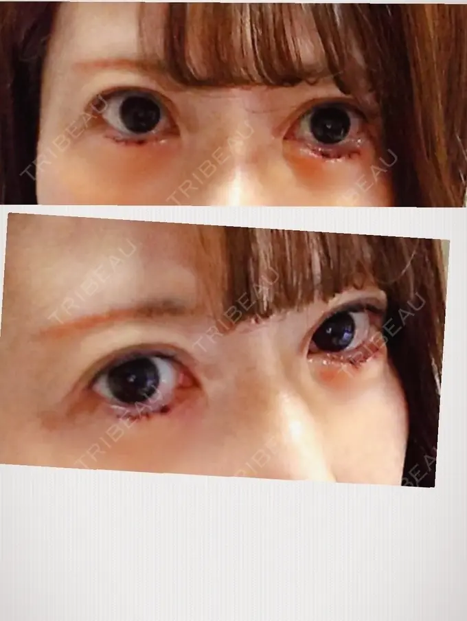 糸リフト / タレ目形成・グラマラスライン（切開） / ボトックス（あご） 品川スキンクリニック広島院 DAY 5 メイン用