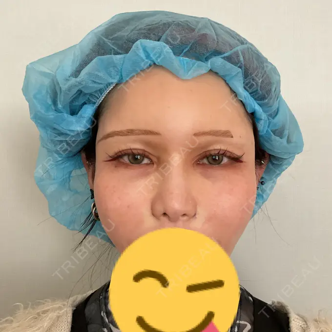 小鼻縮小（非切開） 形成外科と美容外科のクリニック池袋 DAY 0 メイン用