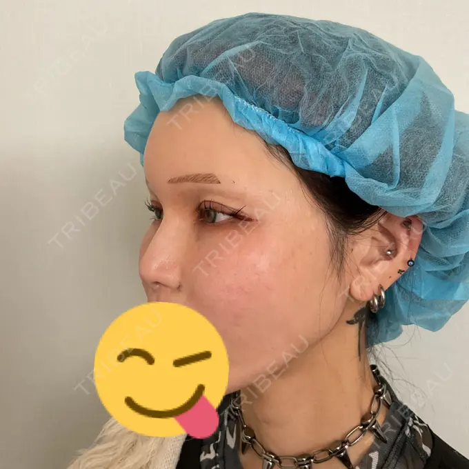 小鼻縮小（非切開） 形成外科と美容外科のクリニック池袋 DAY 0 メイン用