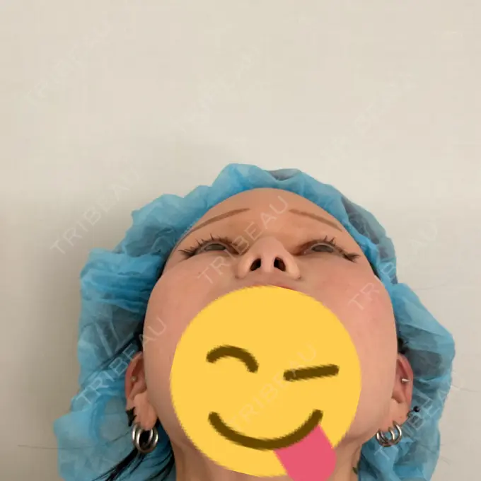 小鼻縮小（非切開） 形成外科と美容外科のクリニック池袋 DAY 0 メイン用